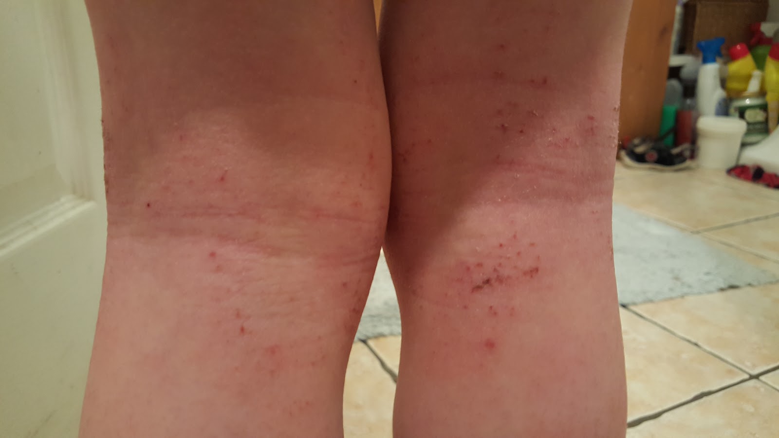 Eczema Behind Knees